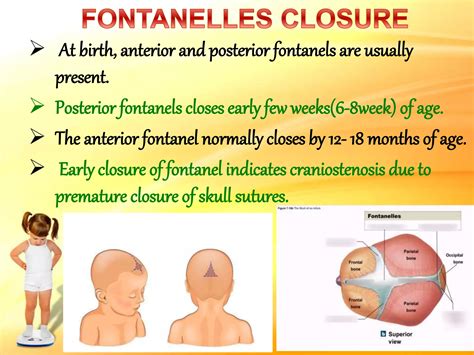 Closure Anterior Fontanelle