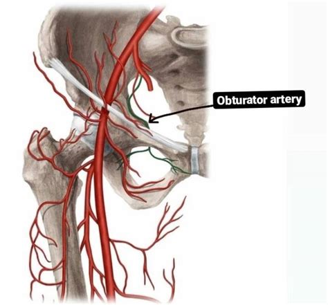 Aberrant Obturator Artery Femoral Hernia