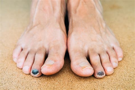 What Is Runner’s Toe, and How Can You Prevent It? | The Output by Peloton