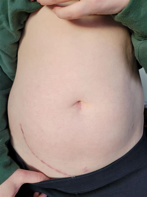 Kidney Transplant Scar