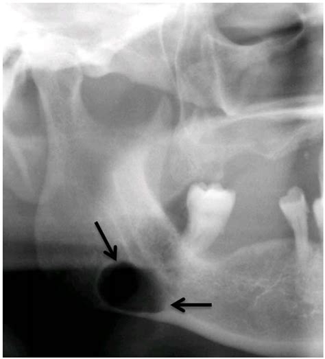 Simple Bone Cyst Mandible