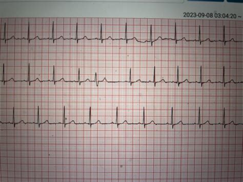 Image result for PVC ECG Reading