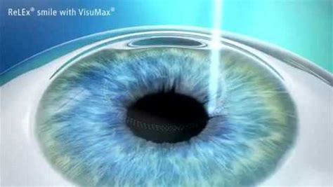 近视眼手术亲身经历全过程-术前检查篇 - 知乎