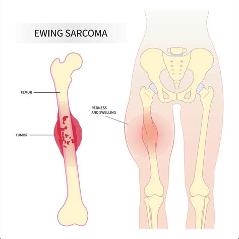 The Silent Bone Cancer Threat: Understanding Ewing’s Sarcoma
