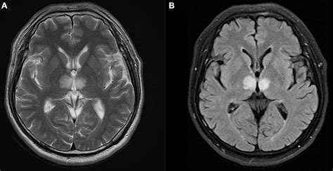 Frontiers | Case report: Artery of Percheron infarction as a rare complication during atrial ...
