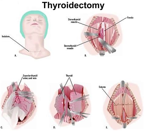 What's A Thyroidectomy