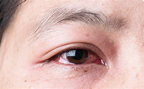 眼睛越柔越痒！过敏性结膜炎怎么治能根除？对症治疗很关键-12健康