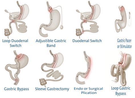 Leak Sites – Bariatric Surgery Education