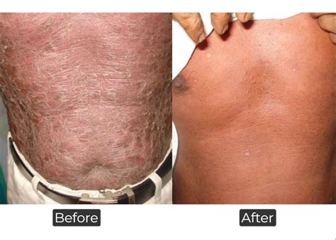 Herbal Psoriasis Treatment & Counselling Clinic