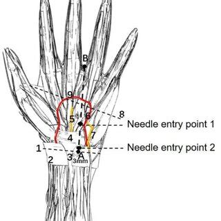 Image result for Locating Needle Decompression Site Using Open Hand as Guide