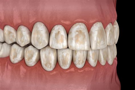 Brown Spots on Teeth (Causes, Prevention & Treatment)