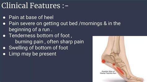 Planter fasciatis .pptx