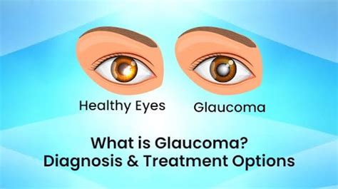 What is Glaucoma? Diagnosis & Treatment Options