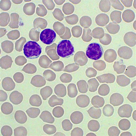 Image result for Lymphocyte Precursor