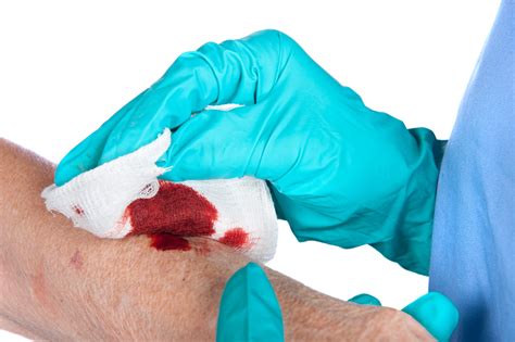 Severe Burns Treatment: First Aid Steps for an Emergency