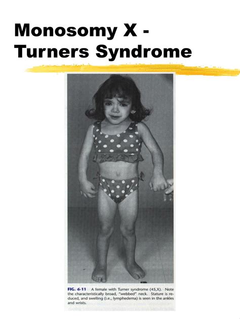 Turner Syndrome Trisomy Or Monosomy at Morgan Hamilton blog