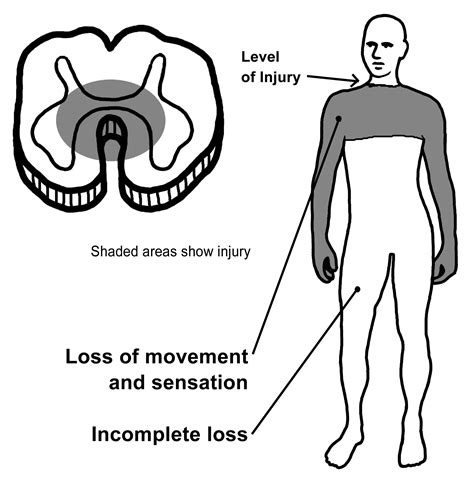 Anterior Cord Syndrome Symptoms
