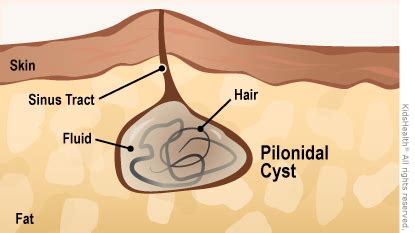 For parents: A to Z: Pilonidal Cyst - Kidshealth | Akron Children's
