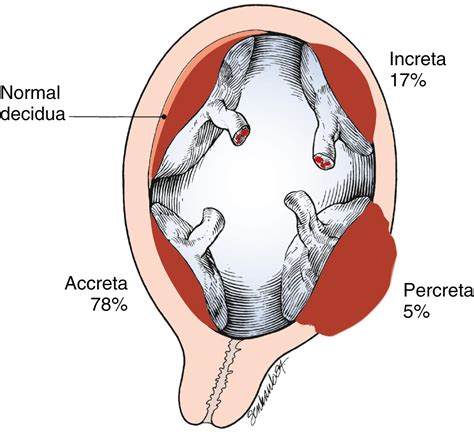Placenta Accreta - Clinical Tree