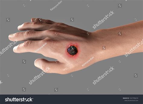 222 Eschar Images, Stock Photos & Vectors | Shutterstock