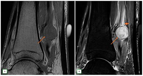 Imaging of Peripheral Intraneural Tumors: A Comprehensive Review for ...