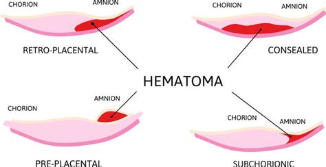 Signs Subchorionic Hematoma Resolving: 5 Critical Causes of Subchorionic Hematoma