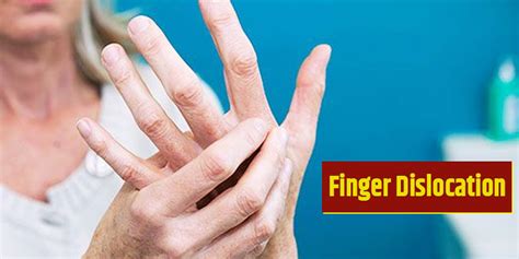 Image result for Finger Dislocation Treatment