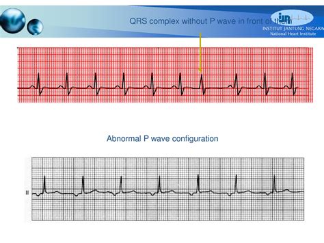 CVT Mohd Farid: Basic ECG Part III-P Wave & PR Interval