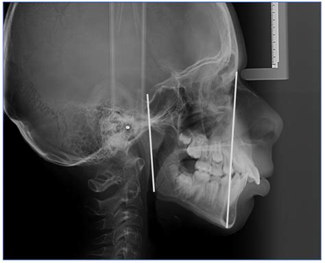 Cephalometric Evaluation of Facial Height Ratio and Growth Patterns: A ...