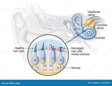 Tinnitus, Healthy And Damaged Hair Cells Inside Cochlea, Medical ...