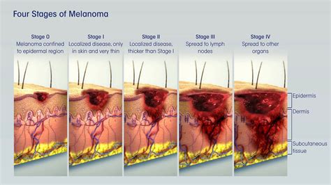 Malignant Melanoma Stage 4