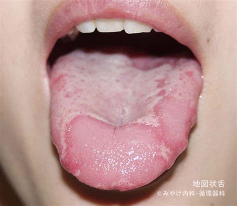 舌 の 病気 写真 - Hello Doctor