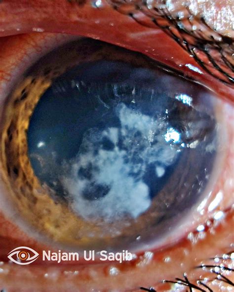 Fungal Corneal Ulcer