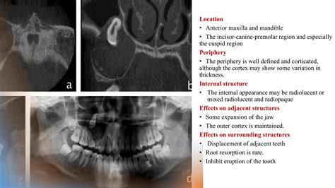 Adenomatoid odontogenic tumor, calcifying epithelial odontogenic tumors and calcifying ...