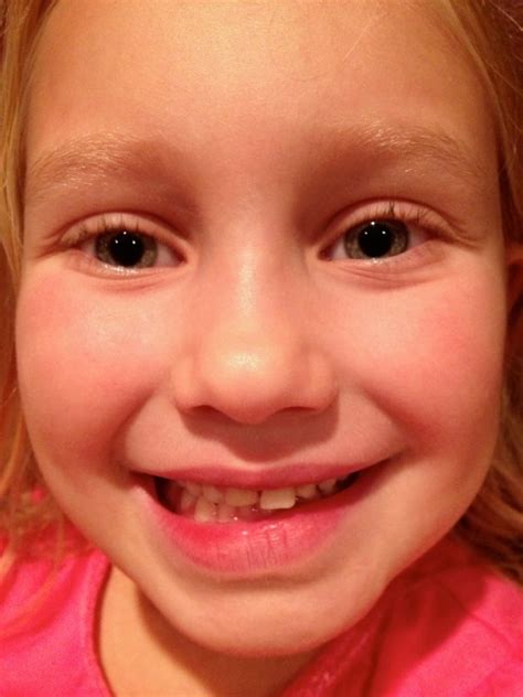 Image result for Lost Tooth