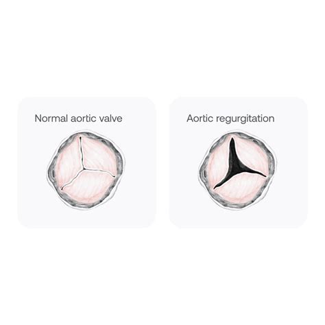 Aortic Valve Regurgitation