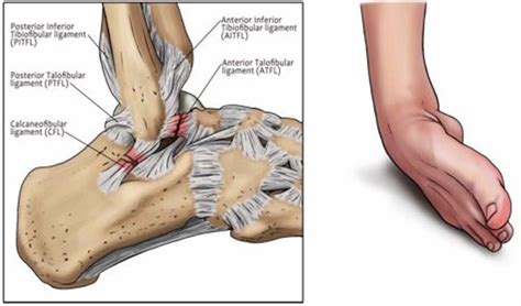 Sprained ankle symptoms, sprained ankle treatment and recovery time