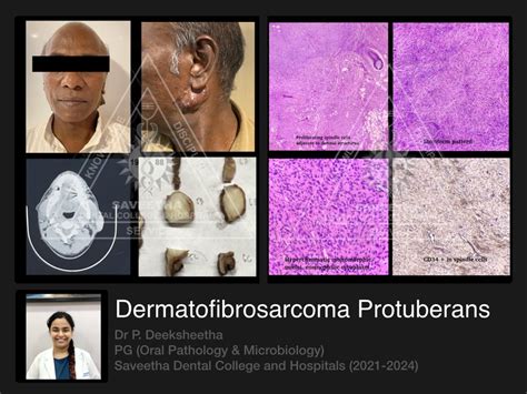 Image result for Dermatofibrosarcoma Protuberans