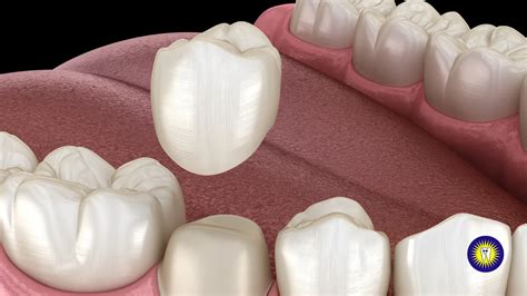 Different Types of Dental Crowns | Liberty Square Dental Group