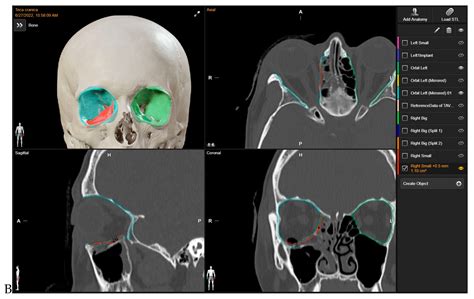 Orbital Floor Fracture Xray