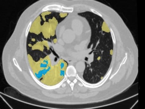 Launch of Gujarat Imaging Center in Ahmedabad, City Scan of Lung can be ...