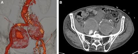 Internal iliac artery aneurysm in a patient with proximal occlusion at ...