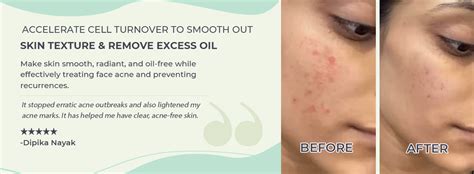 Buy Acne Face Cleanser For Dry & Sensitive Skin | Teenilicious