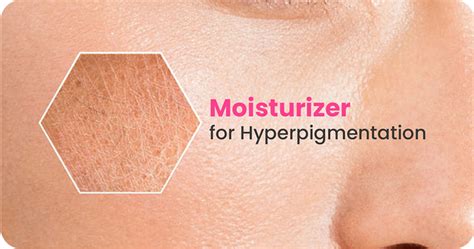 Can Moisturizers Help with Hyperpigmentation?