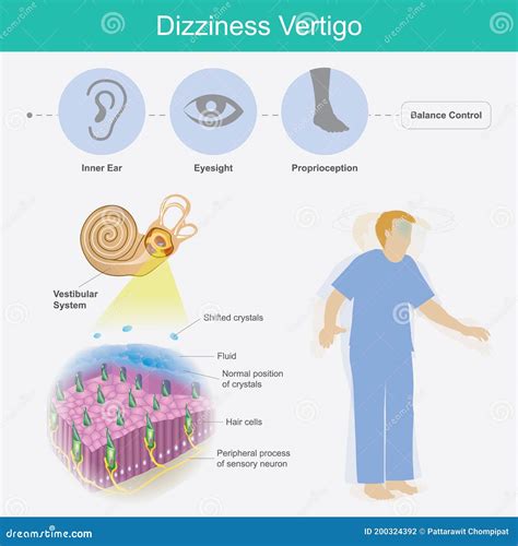 Vertigo Inner Ear Crystals Symptoms
