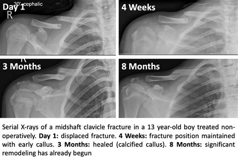 Broken Collarbone Newborn