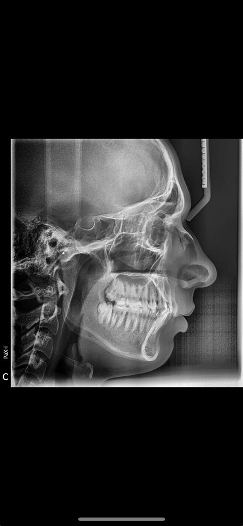 Downswung maxilla and mandible causing weak chin and nose bridge? : r ...