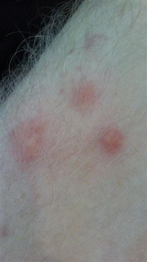 Spider Bites In Bed