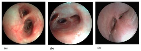 Clinical Relevance of Distinguishing Between Three Endoscopy-Based ...