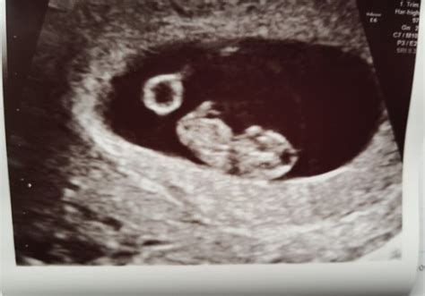 Eco 8 semanas! | BabyCenter